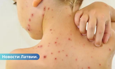 Врачи нужно вакцинироваться, в Латвии выявлен случай заболевания корью.