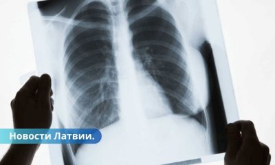 Для получения ВНЖ в Латвии нужен рентген легких. Зачем