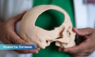 ФОТО: в Латвии подростку заменили часть черепа на 3D-печатную кость.