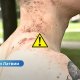 Видео ⟩ чудо в Риге: мужчина выжил после удара молнии.