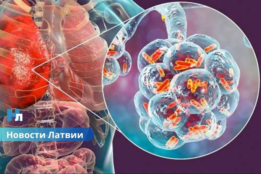 🚨В Юрмале обнаружен легионеллез: опасная бактерия в воде — что делать и как защититься?