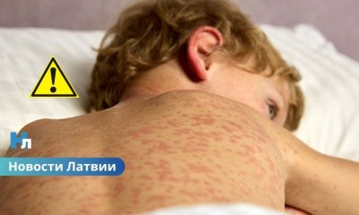 🚨 Вспышка кори в Латвии набирает обороты: уже 24 заболевших, большинство — дети.