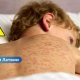 🚨 Вспышка кори в Латвии набирает обороты: уже 24 заболевших, большинство — дети.