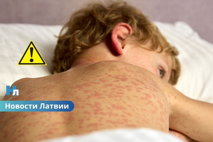 🚨 Вспышка кори в Латвии набирает обороты: уже 24 заболевших, большинство — дети.