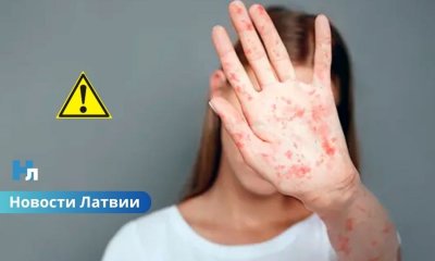 В Латвии зарегистрировано уже 42 заболевших корью: врачи комментируют ситуацию.