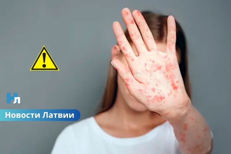 В Латвии зарегистрировано уже 42 заболевших корью: врачи комментируют ситуацию.